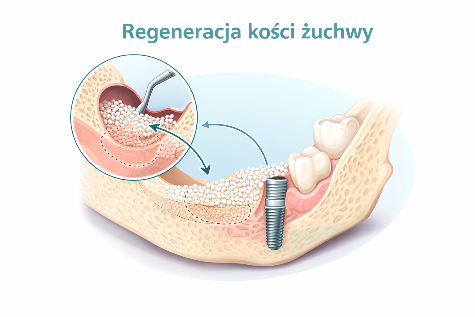 Regeneracja kości żuchwy